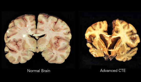 Chronic Traumatic Encephalopathy (CTE) Chapelboro com