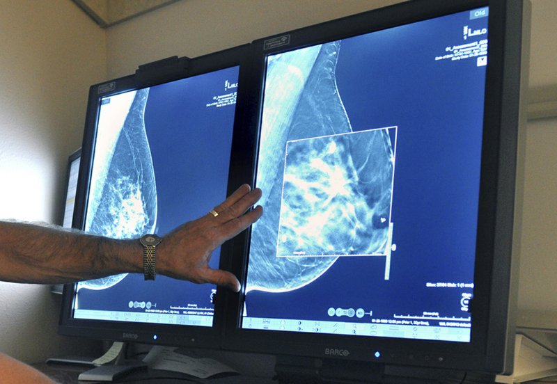 Cancer Death Rate Expected To Rise From Missed Screenings in 2020