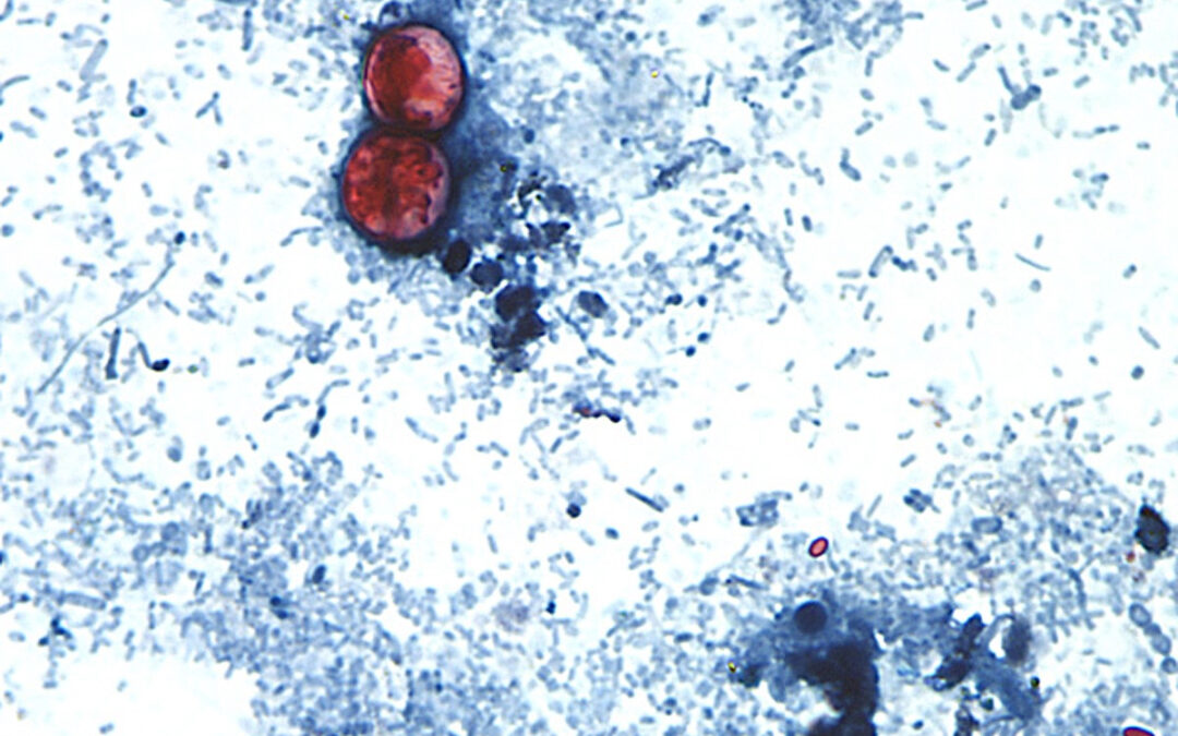 Outbreak of Diarrhea-Causing Parasite Grows to More Than 1,000 Cases