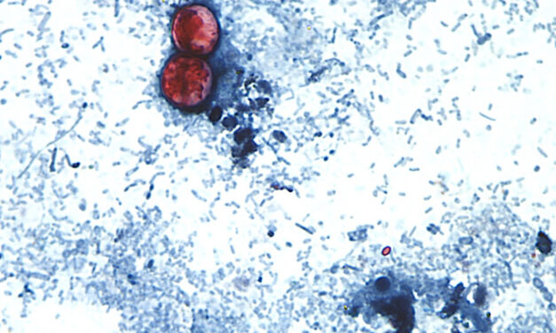 Cases of Diarrhea Parasite Reported in Orange County, Health Department Shares Guidance